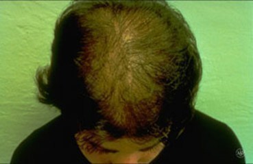 What can cause hair loss in young females?